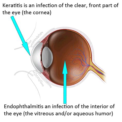 Definition of Fungal Eye Infections | Types of Diseases ...