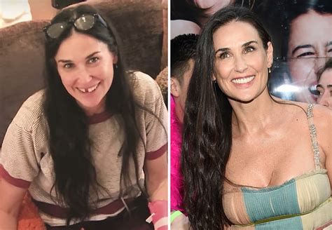 Demi Moore’s Cosmetic Dentistry | Dr. Gentry