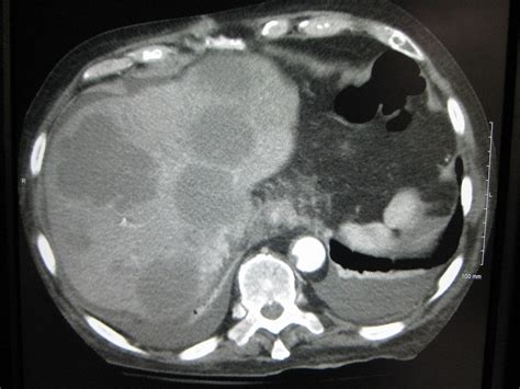 Department of Surgery   Liver Metastases