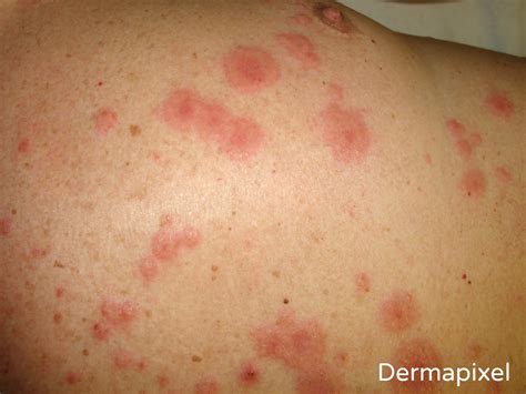 Dermapixel: Fiebre y ronchas en la piel