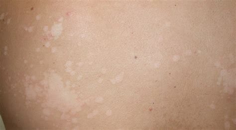 Dermapixel: Hongos en la piel