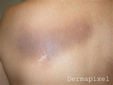 Dermapixel: Una mancha en la espalda