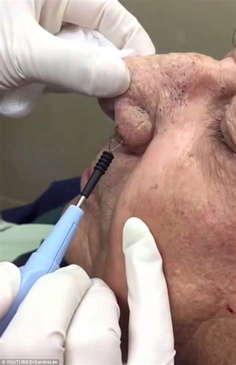 Dermatologist known as  Dr Pimple Popper  has become a ...