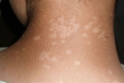 Dermatomicosis   Hongos que infectan la piel en lugares ...