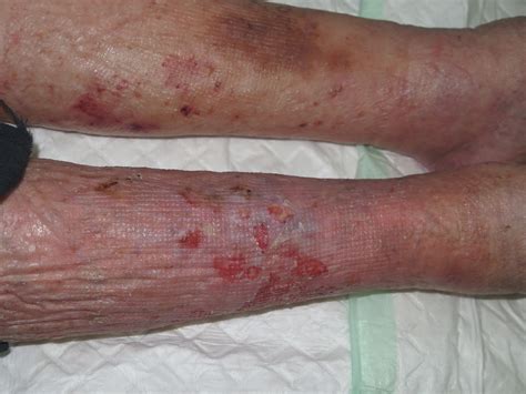Dermatosis pustulosa y erosiva de piernas: posiblemente ...