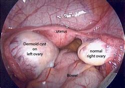Dermoid Cyst   Causes, Pictures, Symptoms And Treatment