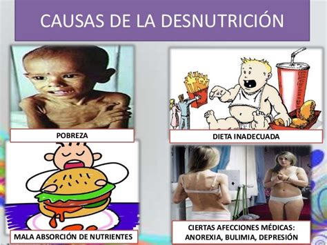 Desnutricion