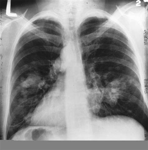Detección de cáncer de pulmón mediante radiografía no ...