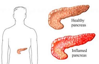 Diabetes lucha diaria: Cuando el páncreas se enferma  2 .