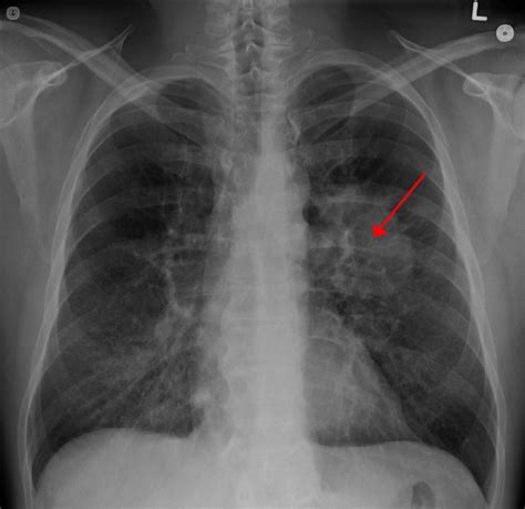 Diagnosticar rapidamente el cancer de pulmon