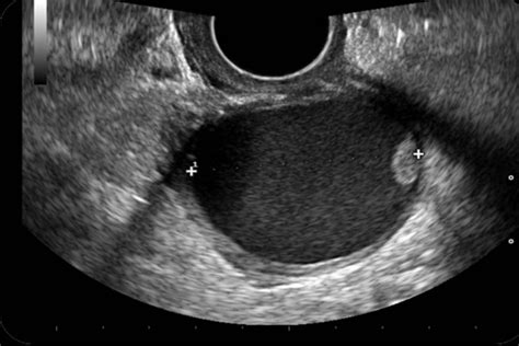Diagnóstico imagenológico de un teratoma gigante de ovario