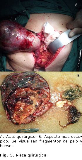 Diagnóstico imaginológico de un teratoma gigante de ovario