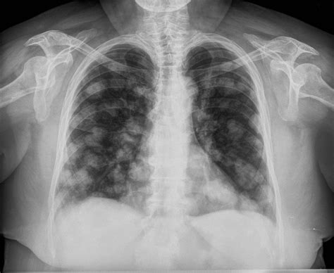 Diagnóstico por Imágenes: Metástasis pulmonares signo ...