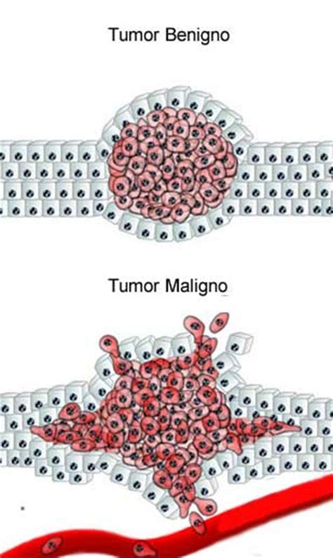 Diferenças entre tumores benignos e malignos