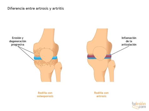 diferencia entre artrosis y artritis