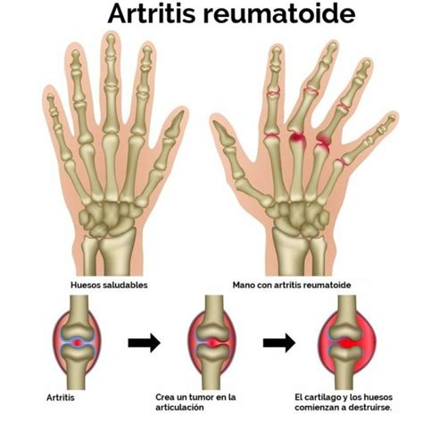 Diferencias entre Artritis y Artrosis cuadros comparativos ...