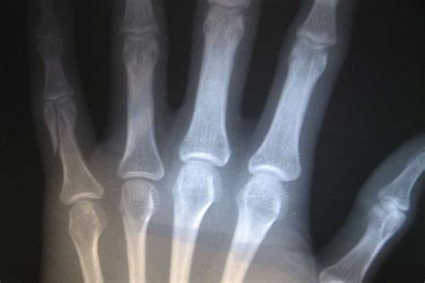 Diferencias entre artritis y artrosis