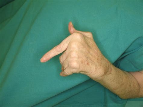 Diferencias entre artrosis y artritis: entre el desgaste y ...