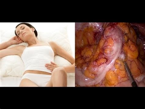 Diverticulose du colon sigmoïde : maladie et chirurgie ...