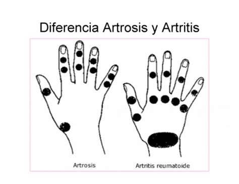 Documento 67._Diferencias_Artrosis_y_Artritis   grupos ...