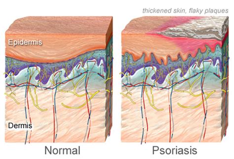 » Does Psoriasis Affect Beauty? Beauty Blog | Makeup ...