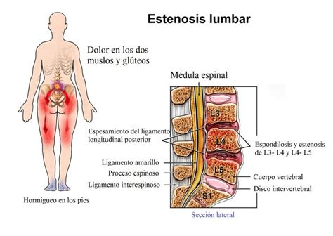 Dolor de espalda baja, intenso, riñones, causas y tratamiento