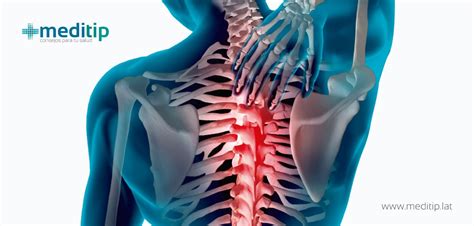 Dolor de espalda: causas, síntomas y tratamiento   Meditip