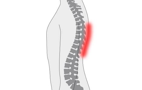 Dolor de espalda media | Causa y tratamiento del dolor de ...