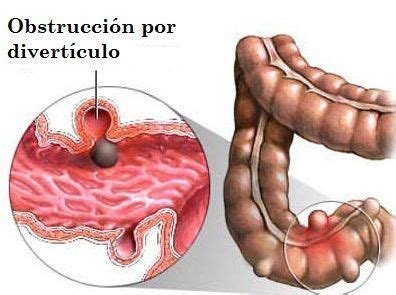 Dolor intestinal por obstrucción