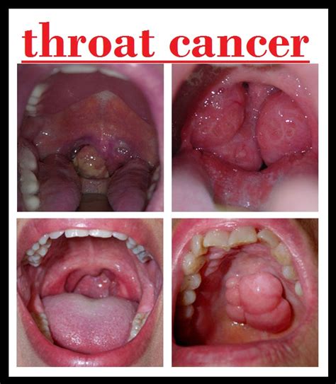 Early Stage Throat Cancer | www.pixshark.com   Images ...