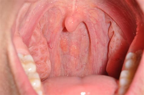 Early Stage Throat Cancer | www.pixshark.com   Images ...