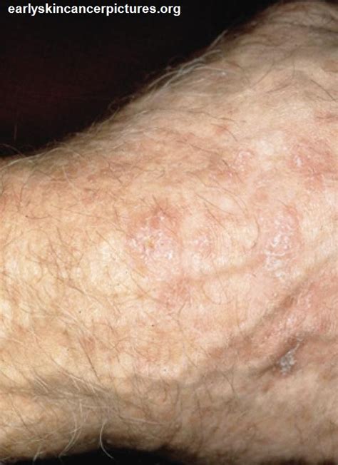 Early Stages Melanoma Skin Cancer Moles ...