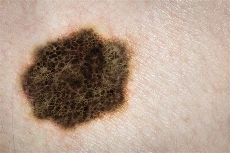 Early Stages Melanoma Skin Cancer Moles ...