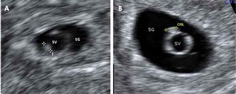 Ecografía del embrión de la semana 5: Crece 1 milímetro ...