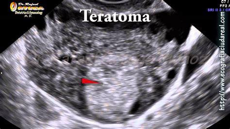 Ecografia Ginecologica 2D Teratoma ovarico o quiste ...
