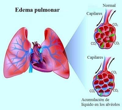 Edema pulmonar agudo, causas, cardiogénico, encharcamiento ...