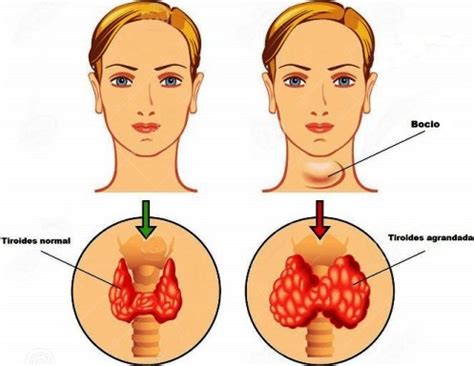 Efectos Secundarios Del Hipotiroidismo Síntomas Tiroides