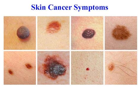 Effectively Dealing with Skin Cancer | VICTORY OVER CANCER