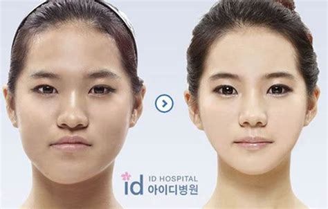 El antes y después: cirugía plástica en Corea 2   Marcianos