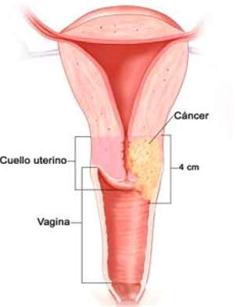 El cáncer de cuello uterino se puede curar | Visión Salud