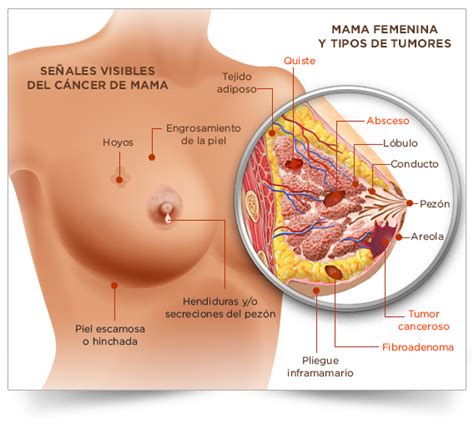 El cáncer de mama asociado con agentes contaminantes ...