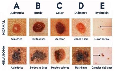 El cáncer de piel | DEBATE