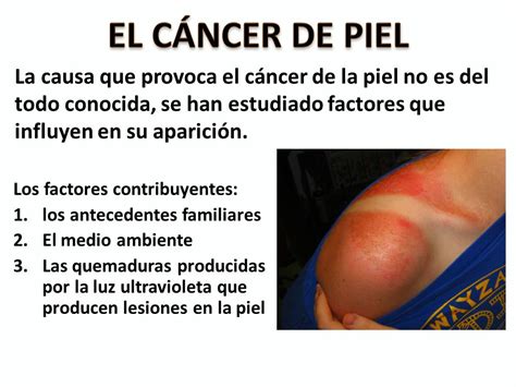 EL CÁNCER DE PIEL La causa que provoca el cáncer de la ...