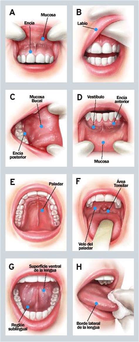 El cáncer oral: síntomas, factores de riesgo, tratamiento ...