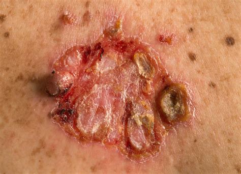 El carcinoma basocelular y espinocelular en el piel