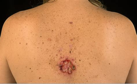 El carcinoma basocelular y espinocelular en el piel