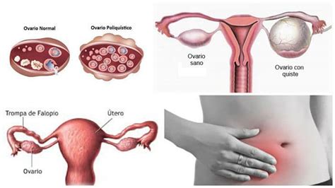 El Dolor de Ovario: Causas, Síntomas y Tratamientos ...