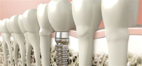 El implante, ¿en mi dentista o en una franquicia dental ...