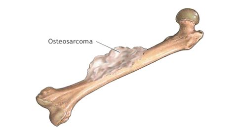 ¿El Osteosarcoma infantil, es curable? • El Nuevo Diario