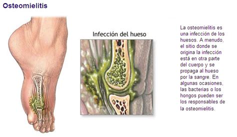 EL SISTEMA ÓSEO: ENFERMEDADES..!